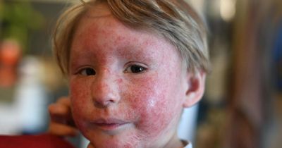 Mum needs £4,000 to fly son abroad for life-changing eczema therapy