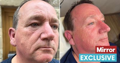 Lorry driver ages dramatically on one side of his face - as he never wore SPF behind the wheel