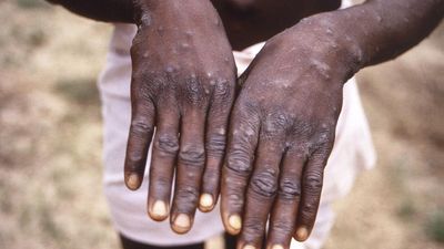 Emerging monkeypox outbreaks in Asia-Pacific region