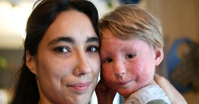 Mum's 'heartbreak' at 'disgusted' looks given to her son, 3, with severe eczema