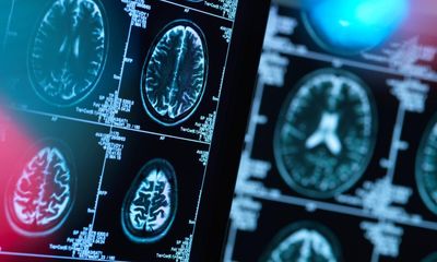 Two epilepsy patients’ seizures greatly reduced in stem cell therapy trial