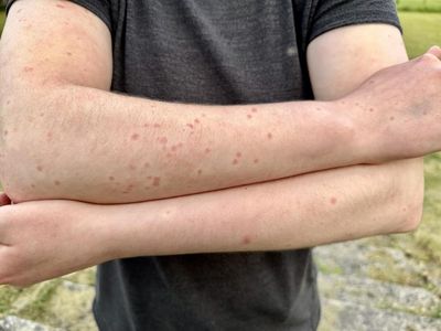 Midge expert urges Scots to be prepared for 'crazy' numbers in West of Scotland