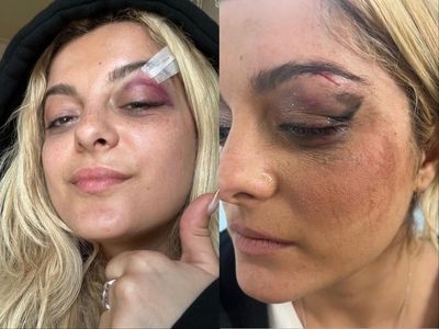 Bebe Rexha shows off injuries after phone-throwing fan charged with assault