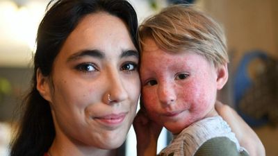 Desperate Mom Pleads For Help To Fund Life-Changing Treatment For Toddler’s Severe Eczema