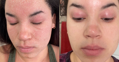 "Boots 'magic' £12 skincare range completely cleared my painful eczema in 10 days", claims beauty buff