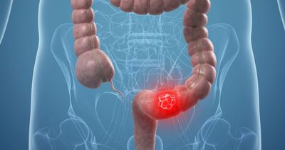 'Testing twice for bowel cancer increases detection and could be key to saving lives'