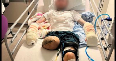Man mocks gang who chopped his leg and fingers off with a machete from his hospital bed