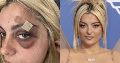 Bebe Rexha shares update on 'black and blue' eye after shocking stage attack