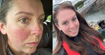 'My awful skin condition put a downer on my pregnancy until I discovered a miracle cure'