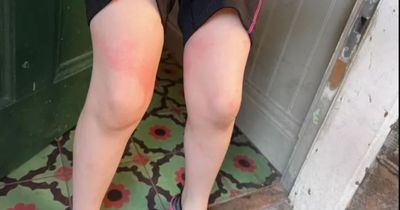 Scots mum left in 'worst pain' of life after getting stung by jellyfish