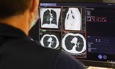 All people in England who have smoked to be offered middle-age lung screening