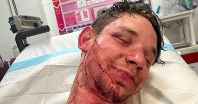 Ukrainian actor performing at Abbey Theatre hospitalised after thugs smash glass bottle off his head
