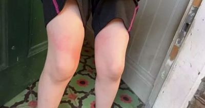 Mum left in 'worst pain of life' after being stung by jellyfish on UK beach