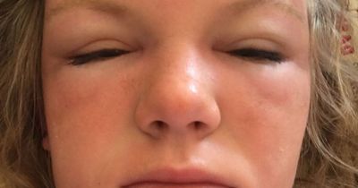 Woman barely able to open eyes after beach mistake triggered sun poisoning