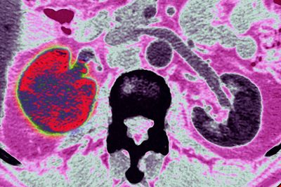 Kidney Cancer Drug May Repair Brain Blood Vessels