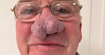 Scots grandad forced to pay to have huge nose growth removed and slams NHS for lack of help