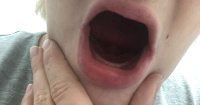 Woman lost all her teeth due to condition during pregnancy