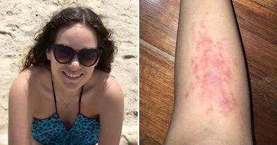 'I thought I just had a rash - but a parasite was living inside my leg and laying eggs'