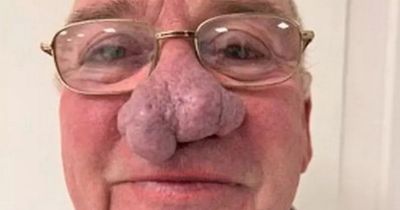 Grandad with large nose growth pays to have it removed after being fobbed off by NHS