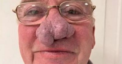 Grandad with large nose growth pays to have it removed after being fobbed off by NHS