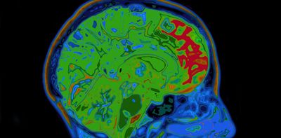 People with obsessive-compulsive disorder have an imbalance of brain chemicals – our discovery could mean a treatment breakthrough