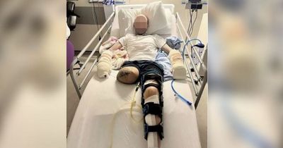 'Ya bunch of f*****g dafties': Man taunts gang who hacked his leg off with a machete