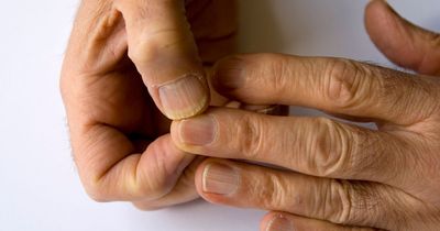 Subtle lung cancer warning sign that you may spot in your fingers