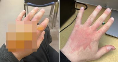 Teen left with blister as big as an ORANGE after touching 'UK's most dangerous plant'