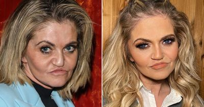 Danniella Westbrook surgery journey - nose collapse, horror surgery to crumbling cheeks