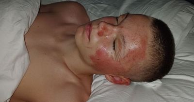 Glasgow schoolboy rushed to hospital with serious burns after aerosol can 'explodes in fire'