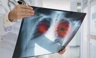 Lung cancer symptoms: what to look out for