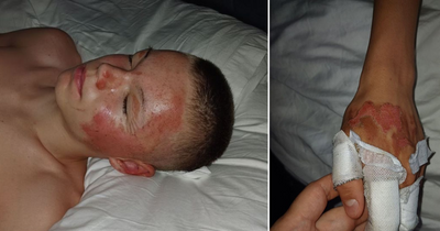 Scots teen burned by 'exploding' aerosol can as dad feared 'we could have lost him'