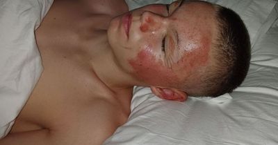 Schoolboy taken to hospital with serious burns after aerosol explodes