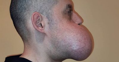 Surgeons rebuild man's FACE after removing huge tumour that stopped him breathing