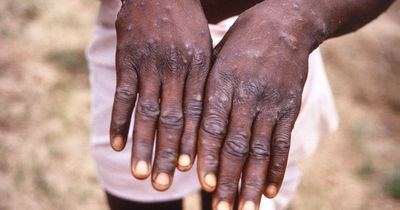 Urgent monkeypox symptoms warning as new cases seen popping up around the UK