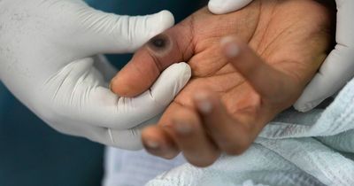 Expert warning over monkeypox symptoms as virus spreads in UK