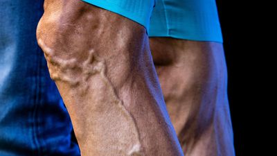 Ask The Expert: Why are my legs so veiny?