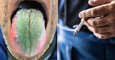 Man's tongue turned green and hairy due to rare reaction to cigarettes