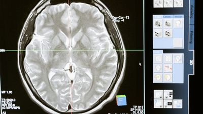 Fastball EEG Test Receives Funding Boost To Improve Early Detection Of Dementia