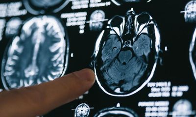 Make brain scans routine for new psychosis patients, experts say