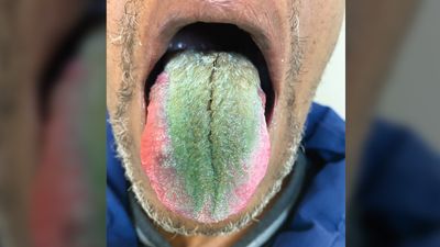 Man sprouted thick, green 'fur' on his tongue in odd medical case