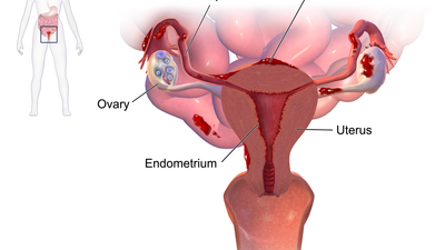 The curious link between endometriosis and an infectious bacterium