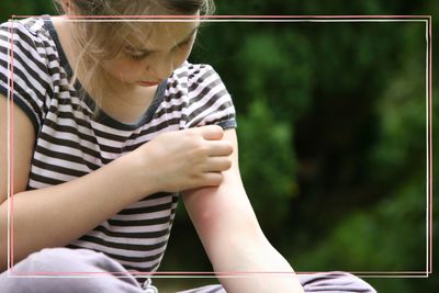 Common types of insect bites in the UK and doctor advice on how to treat them and stop your child itching