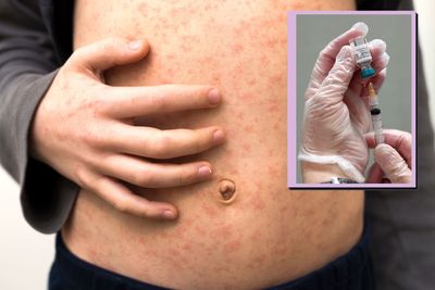 Dr Sara Kayat joins NHS call for parents to act as measles cases rise
