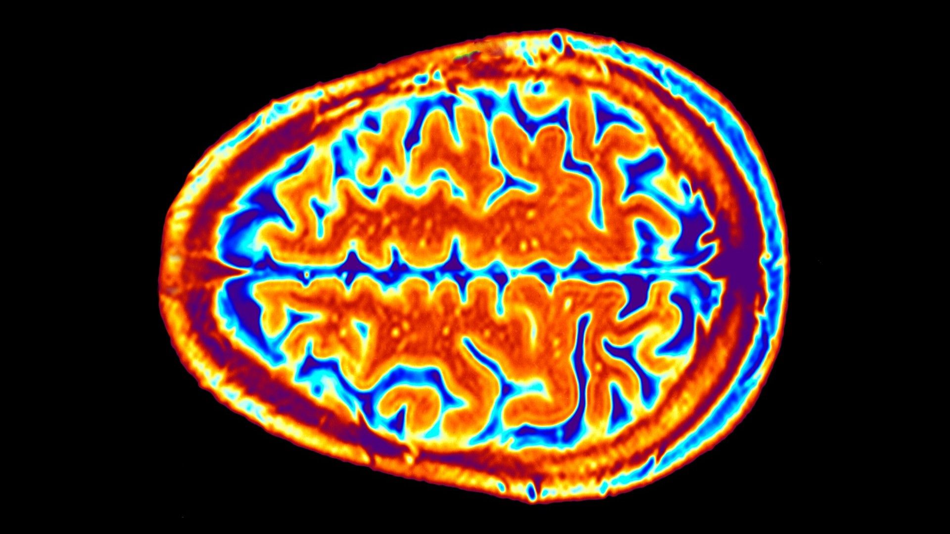 smoothness-in-parts-of-brain-s-surface-may-boost