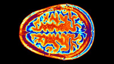 'Smoothness' in parts of brain's surface may boost risk of depression, study suggests