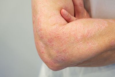 Psoriasis Awareness Month: Everything you need to know