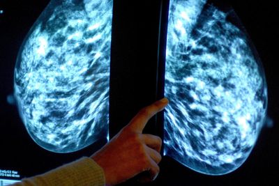 ‘AI may be able to safely assess breast cancer scans’