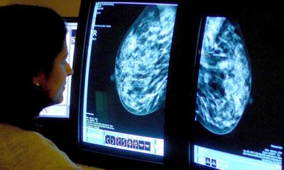 AI use in breast cancer screening as good as two radiologists, study finds