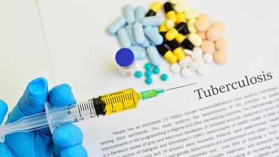 Trial done in India shows nutrition support prevents TB, related deaths